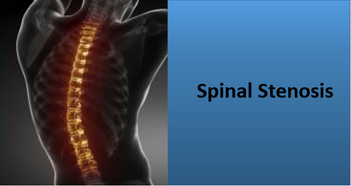 https://www.mehtaspine.co.uk/blog/wp-content/uploads/2019/01/Spinal-Stenosis.png